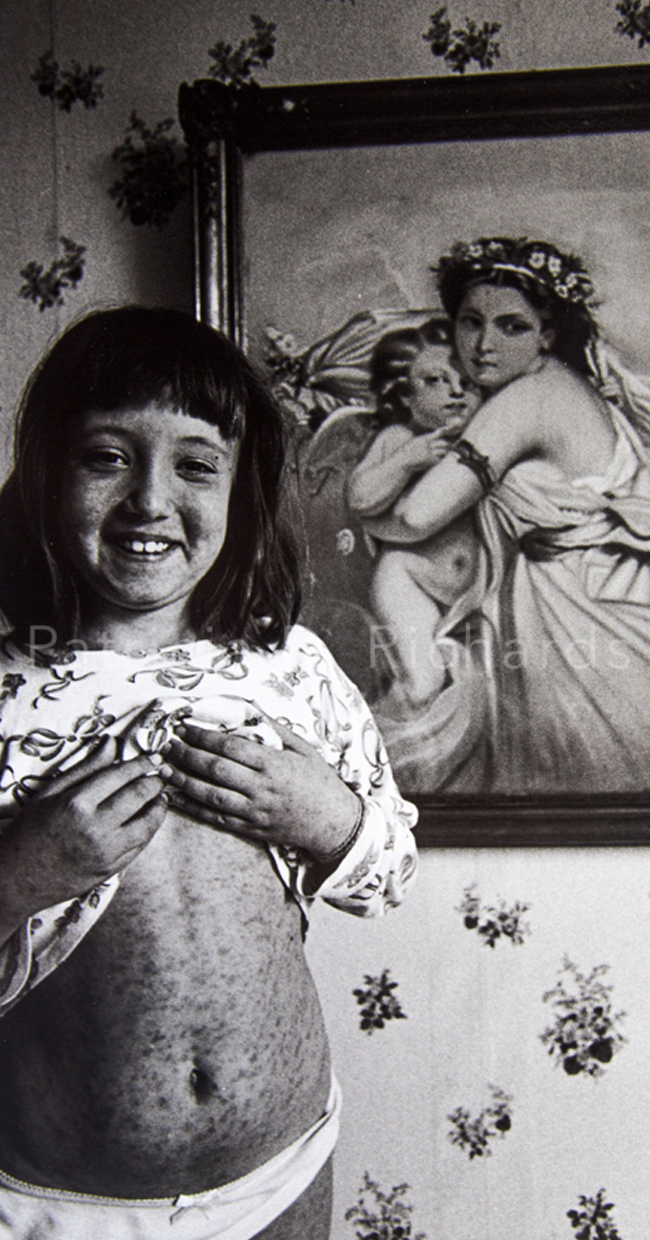angeliques measles